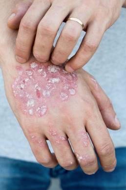 Psoriasis auf Hand