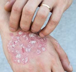 Psoriasis auf Hand